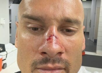 Maicon recebeu pontos no nariz após a partida contra o Athletico-PR.