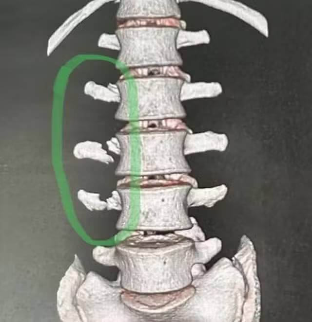 capasso-fratura Capasso mostra lesão nas costas